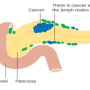 Cannabis Chemical May Have ‘Major Impact’ On Pancreatic Cancer Treatment